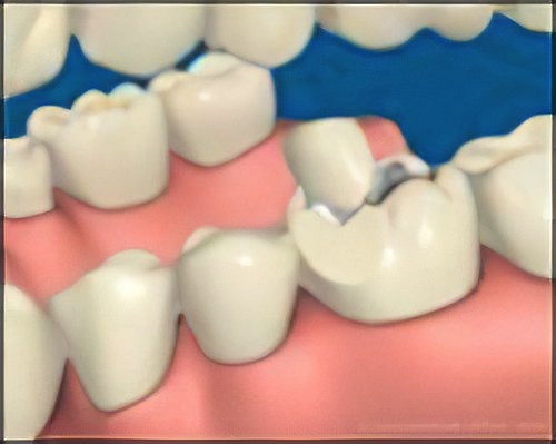 Couronne Dentaire Le Fossat Fracture-Dentaire-Petite