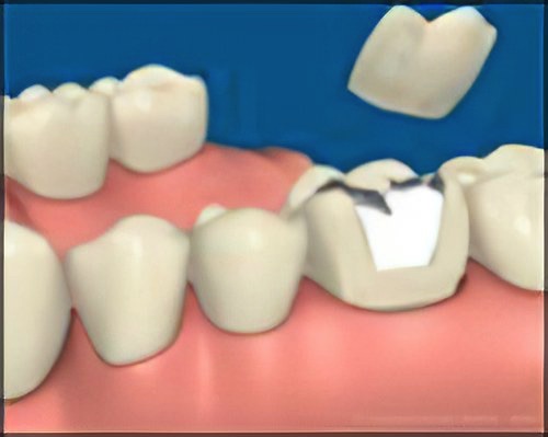 Couronne Dentaire Le Fossat Fracture-Dentaire-Profonde