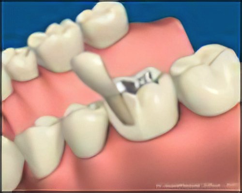 Couronne Dentaire Le Fossat Fracture-Dentaire-Trop-Profonde