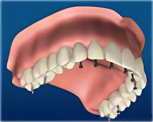 bridge sur implants dentaires Le Fossat