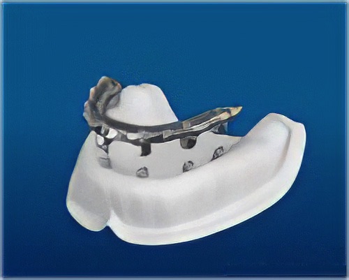 dentier sur implants dentaires Le Fossat