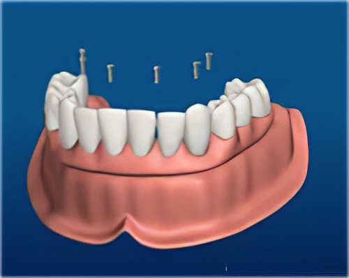 dentier vissé sur implants dentaires Le Fossat