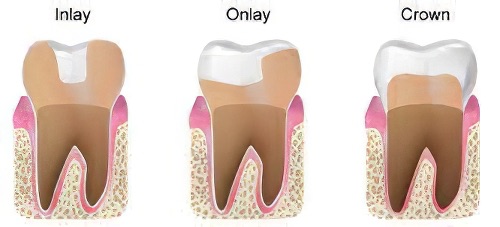 traitements dentaires Le Fossat inlay onlay couronne