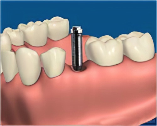 Remplacer une dent le Fossat couronne sur implants