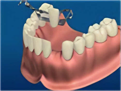 Remplacer des dents manquantes le Fossat prothèse amovibles