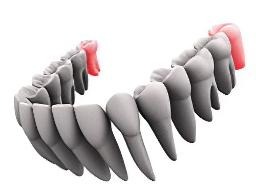 dents de sagesse